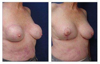 Breast Sagging Los Angeles Breast Sagging Los Angeles