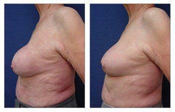 Mommy Makeover Mommy Makeover
