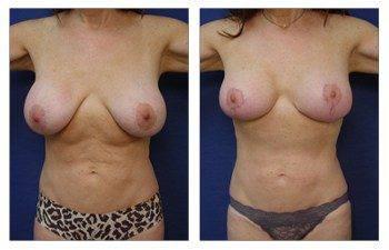breast augmentation revision recovery patient 9 front view - Breast Augmentation Revision Of Aged breast augmentation revision recovery patient 9 front view - Breast Augmentation Revision Of Aged