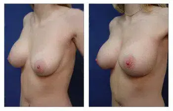 A woman's breasts undergoing a breast augmentation for revision of deflated implant. A woman's breasts undergoing a breast augmentation for revision of deflated implant.