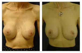 A woman's breasts before and after breast augmentation surgery. A woman's breasts before and after breast augmentation surgery.