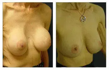 Before and after photos of breast augmentation surgery. Before and after photos of breast augmentation surgery.