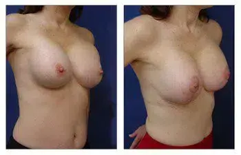 A woman's breast before and after Breast Augmentation surgery. A woman's breast before and after Breast Augmentation surgery.