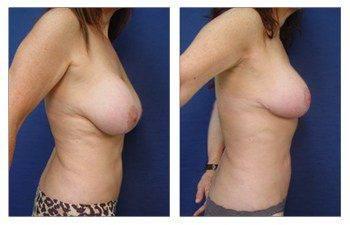 breast augmentation revision recovery patient 9 right view