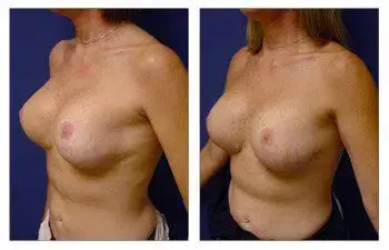 Before and after breast augmentation surgery performed by a revision surgeon. Before and after breast augmentation surgery performed by a revision surgeon.