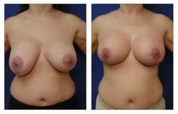 A woman's breast before and after breast augmentation surgery by a revision surgeon in Newport Beach. A woman's breast before and after breast augmentation surgery by a revision surgeon in Newport Beach.