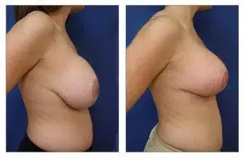 Before and after breast augmentation surgery. Before and after breast augmentation surgery.