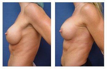 breast augmentation revision surgery patient 11 left view