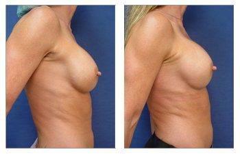 breast augmentation revision surgery patient 11 right view