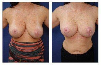Breast Augmentation Revision Surgery Recovery Breast Augmentation Revision Surgery Recovery