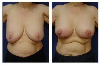 A woman's breasts before and after Breast Augmentation surgery. A woman's breasts before and after Breast Augmentation surgery.