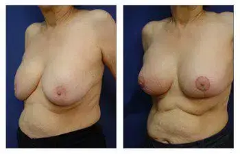 Breast Augmentation: A woman's breasts before and after surgery. Breast Augmentation: A woman's breasts before and after surgery.