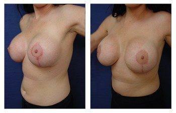 Breast augmentation revision surgery before and after Breast augmentation revision surgery before and after