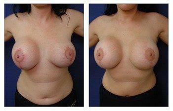 front view Breast Augmentation Revision To Correct Breast Size Asymmetry And Scarring front view Breast Augmentation Revision To Correct Breast Size Asymmetry And Scarring