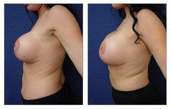 breast-augmentation-revision-patient-4-left breast-augmentation-revision-patient-4-left