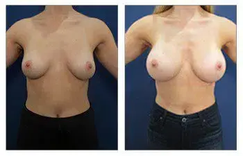 Breast Augmentation Silicone vs Saline Breast Augmentation Silicone vs Saline
