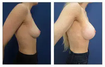 A woman's breast before and after breast augmentation surgery. A woman's breast before and after breast augmentation surgery.