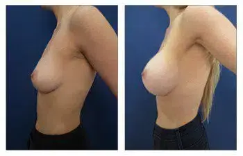 A woman's breast showcasing visible transformation post Breast Augmentation with Silicone implants. A woman's breast showcasing visible transformation post Breast Augmentation with Silicone implants.