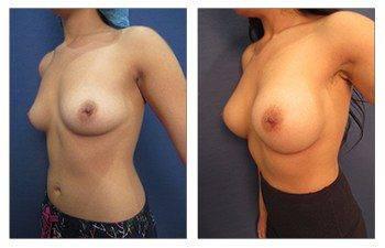 Breast Augmentation — #SS387 Breast Augmentation — #SS387