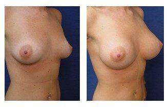 Breast Augmentation Surgery Price, CPSI, width: 326px; height: 210px; Breast Augmentation Surgery Price, CPSI, width: 326px; height: 210px;
