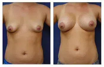 A woman's breast before and after Breast Implant surgery. A woman's breast before and after Breast Implant surgery.