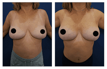A woman's breast before and after Breast Augmentation surgery. A woman's breast before and after Breast Augmentation surgery.