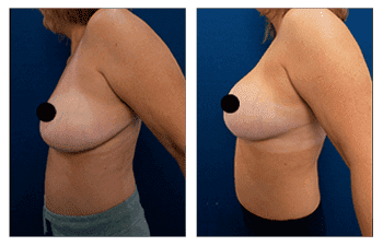 A woman's breast before and after Breast Augmentation surgery. A woman's breast before and after Breast Augmentation surgery.