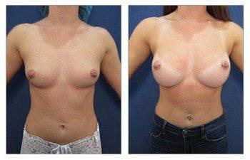 Breast Implant Surgery