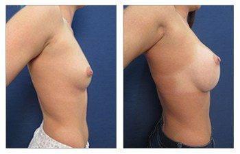 Breast Implant Surgery