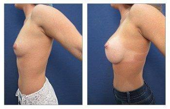 Breast Implant Surgery