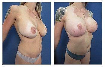Breast Implant Brands Breast Implant Brands