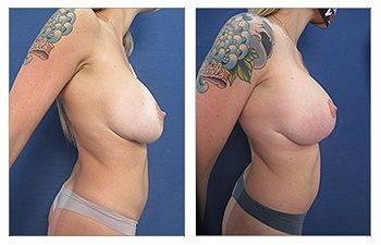 Breast Implant Brands Breast Implant Brands