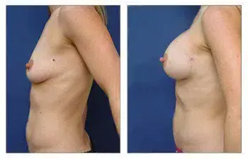 A woman's breast before and after surgery performed by Breast Implant Illness Doctors. A woman's breast before and after surgery performed by Breast Implant Illness Doctors.