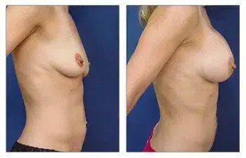 Breast Implant Illness - A woman's breast before and after surgery, guided by knowledgeable doctors. Breast Implant Illness - A woman's breast before and after surgery, guided by knowledgeable doctors.