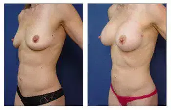 A woman's breast surgery before and after, featuring the expertise of Breast Implant Illness Doctors. A woman's breast surgery before and after, featuring the expertise of Breast Implant Illness Doctors.