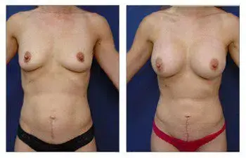Explore the transformative results of a woman's breast surgery, showcasing the remarkable before and after pictures. Explore the transformative results of a woman's breast surgery, showcasing the remarkable before and after pictures.