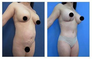 Breast Implant Removal Surgery — photo 2 Breast Implant Removal Surgery — photo 2 | SurgiSculpt®