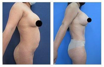 Breast Implant Removal Surgery — photo 3 Breast Implant Removal Surgery — photo 3 | SurgiSculpt®