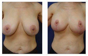 Breast Lift With Implant Augmentation To Decrease Areola Size, CPSI, width: 350px; height: 225px;