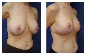 Breast Lift With Implant Augmentation To Decrease Areola Size, CPSI.