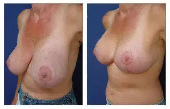 A woman's breasts before and after breast lift surgery. A woman's breasts before and after breast lift surgery.