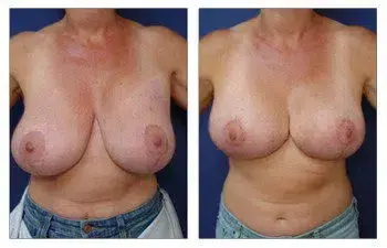 A woman's breasts before and after breast revision surgery. A woman's breasts before and after breast revision surgery.