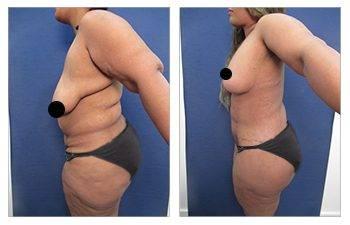 Breast Lift Scars Breast Lift Scars