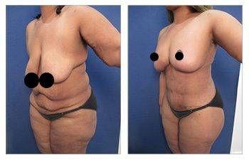Breast Lift Scars Breast Lift Scars