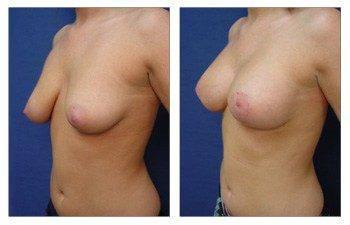 Breast Lift with Implant Augmentation Beverly Hills Breast Lift with Implant Augmentation Beverly Hills