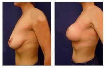 breast-lift-with-implant-augmentation-patient-8-left