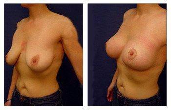 Breast Lift With Implant Augmentation Limitations Breast Lift With Implant Augmentation Limitations