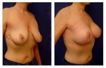 breast-lift-with-implant-augmentation-patient-8-front-right