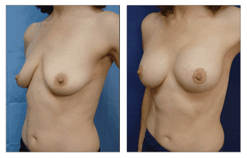 Breast Lift With Implant Augmentation Southern Los Angeles; CPSI. Breast Lift With Implant Augmentation Southern Los Angeles; CPSI.