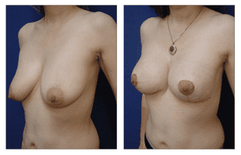 Breast Lift With Implant Augmentation Southern Orange County; CPSI, width: 350px; height: 225px; Breast Lift With Implant Augmentation Southern Orange County; CPSI, width: 350px; height: 225px;